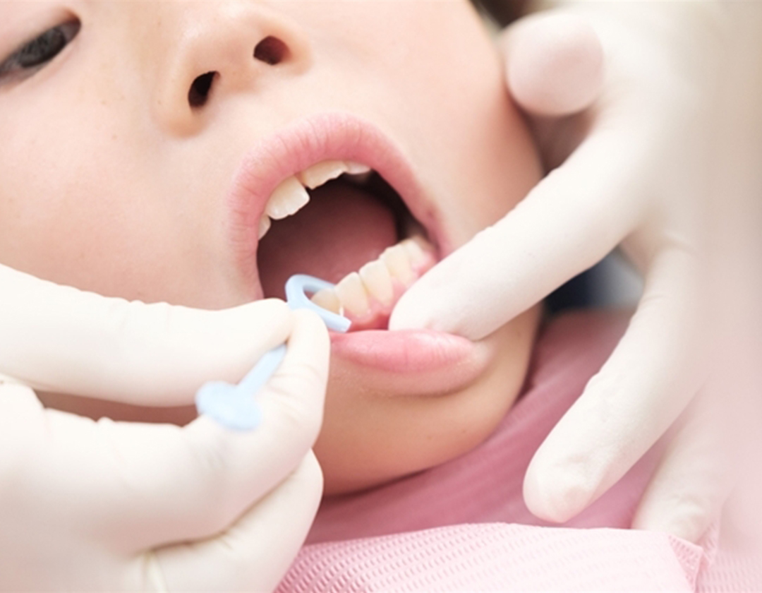 小児歯科で行う治療について