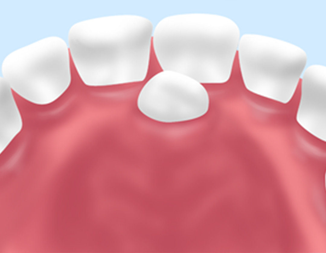 過剰歯の抜歯