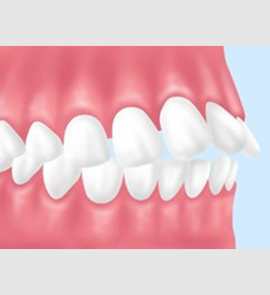 上顎前突（出っ歯）
