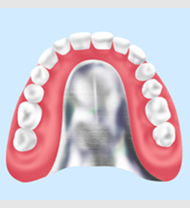 金属床義歯