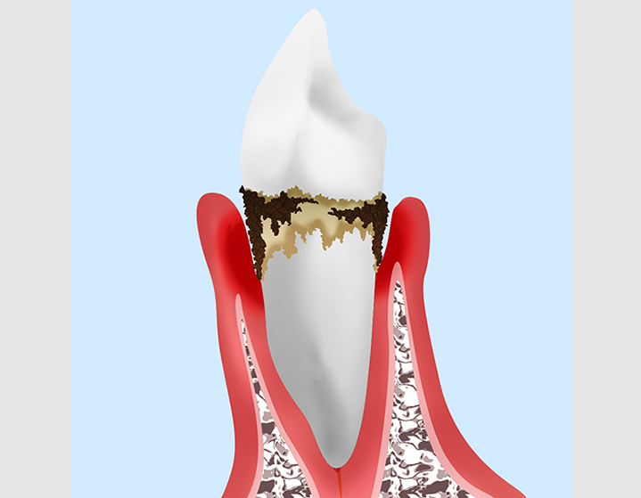 歯周病について