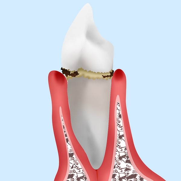 軽度の歯周炎