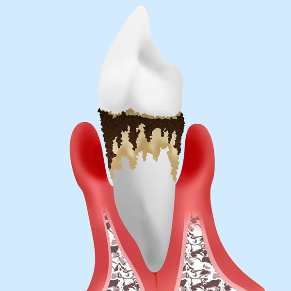 重度の歯周炎