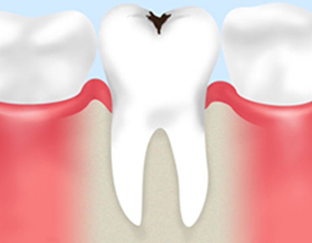小さなむし歯