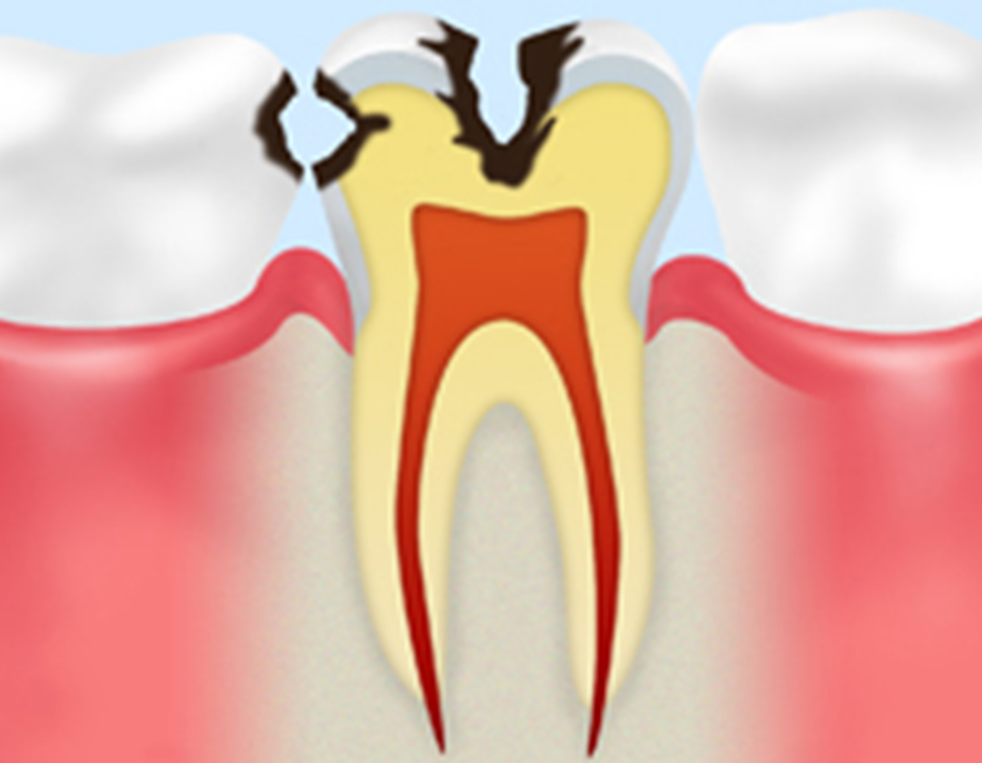 大きなむし歯