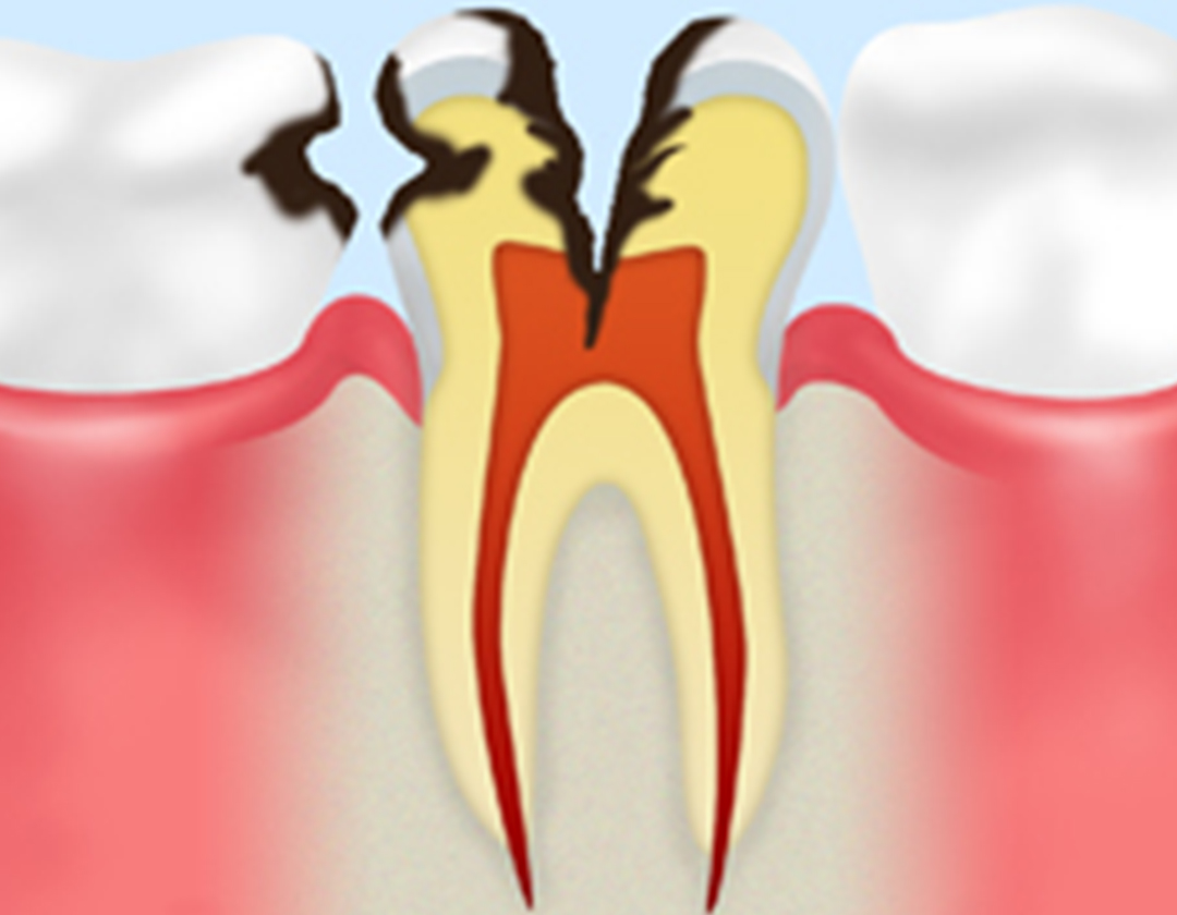 歯の神経まで冒されたむし歯