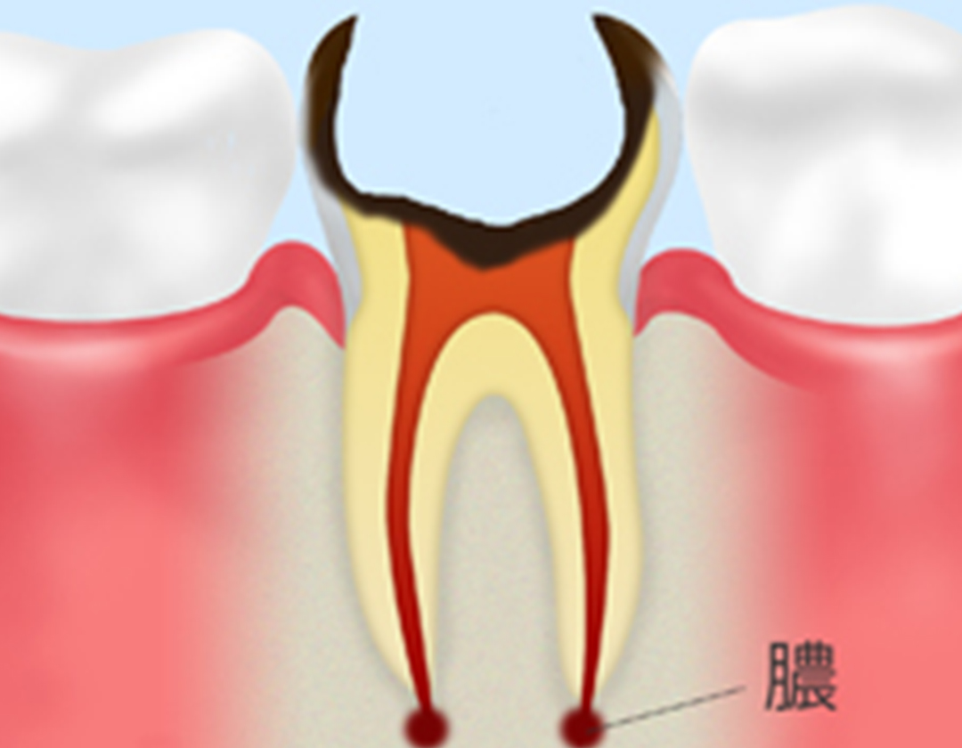 歯の神経が死んでしまっているむし歯
