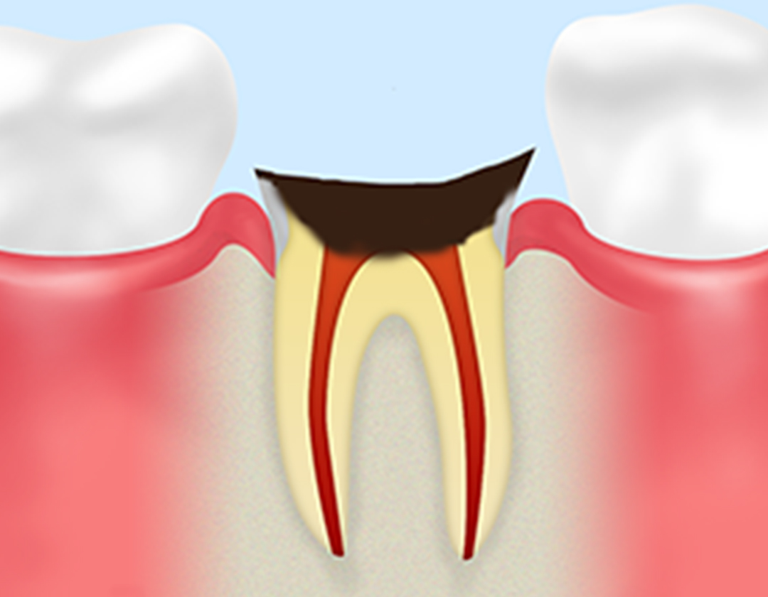 抜歯が必要なほど重症化したむし歯