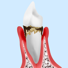 歯周病とは