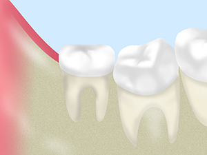 親知らずの抜歯
